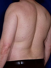 Male Liposuction Before & After