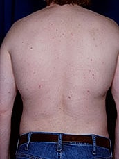 Male Liposuction Before & After