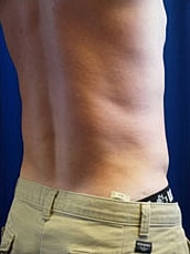 Male Liposuction Before & After