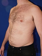 Male Liposuction Before & After