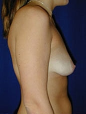 Breast Augmentation With Lift Before & After