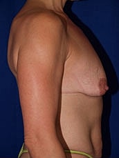 Breast Augmentation With Lift Before & After