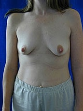 Breast Augmentation With Lift Before & After