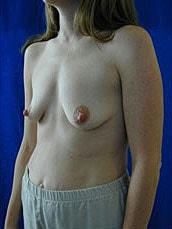 Breast Augmentation With Lift Before & After