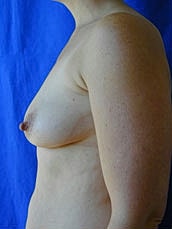 Breast Augmentation With Lift Before & After