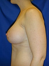 Breast Augmentation With Lift Before & After