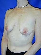 Breast Augmentation With Lift Before & After