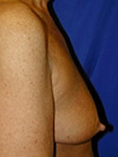 Breast Augmentation With Lift Before & After