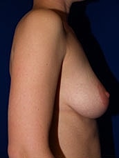 Breast Augmentation With Lift Before & After