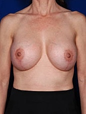 Breast Augmentation With Lift Before & After