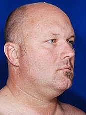 Male Face Neck Before & After
