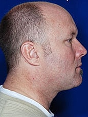 Male Face Neck Before & After