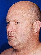 Male Face Neck Before & After