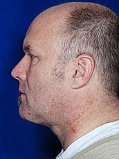 Male Face Neck Before & After