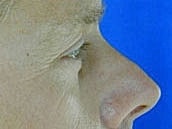 Male Face Neck Before & After