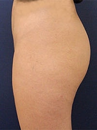 Non Surgical Butt Lift Before & After