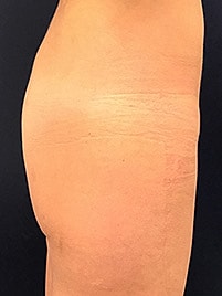 Non Surgical Butt Lift Before & After