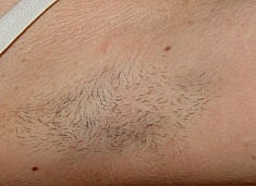 Laser Hair Removal Before & After