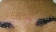Hydrafacial Before & After