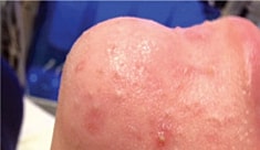 Hydrafacial Before & After