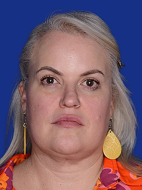 Neck Lift Before & After