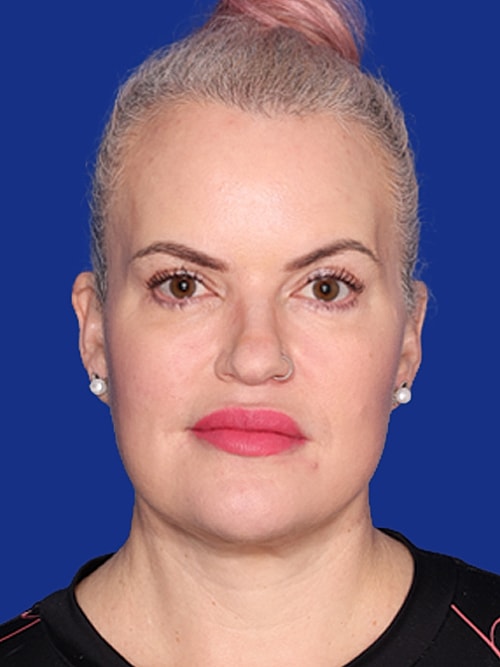 Neck Lift Before & After
