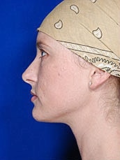 Lip Filler Before & After