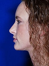 Lip Filler Before & After