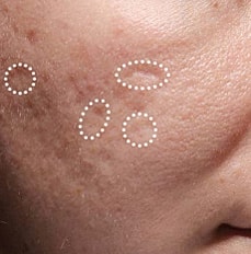 Acne Scar Treatment Before & After