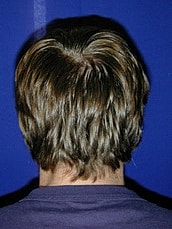 Otoplasty Before & After