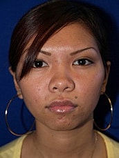 Otoplasty Before & After