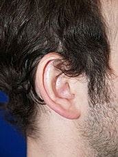 Otoplasty Before & After