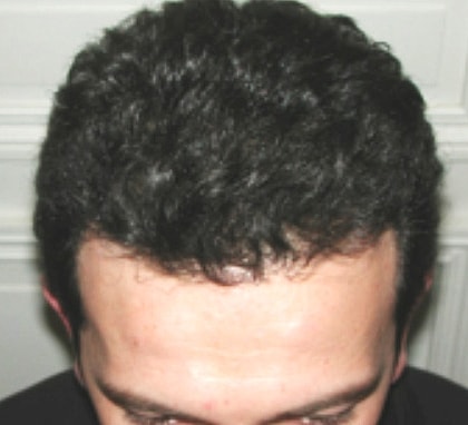 Hair Transplant Before & After