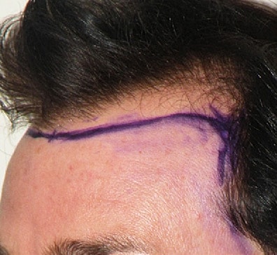 Hair Transplant Before & After
