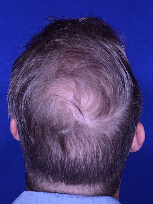 Hair Transplant Before & After