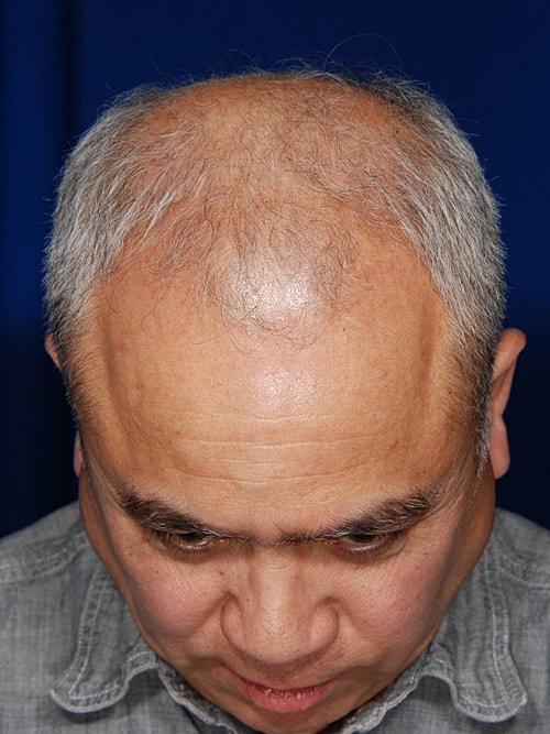 Hair Transplant Before & After