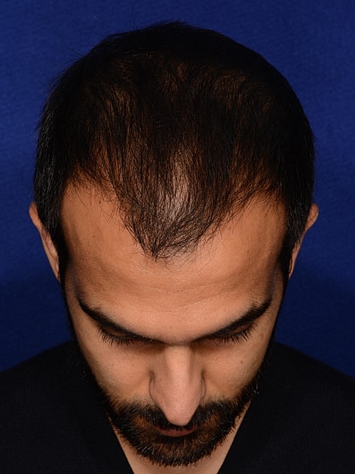 Hair Transplant Before & After
