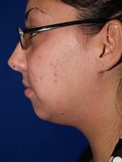 Chin Implant Before & After
