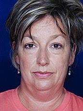 Chin Implant Before & After