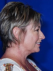 Chin Implant Before & After