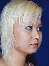 Chin Implant Before & After