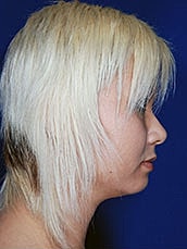 Chin Implant Before & After