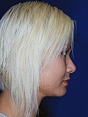 Chin Implant Before & After