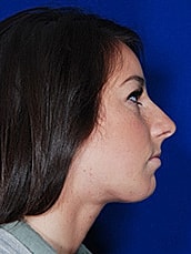 Chin Implant Before & After