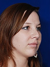 Chin Implant Before & After