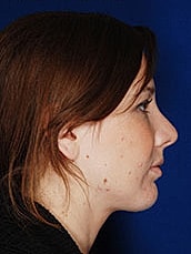 Chin Implant Before & After