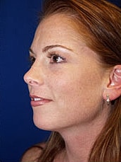 Chin Implant Before & After