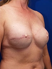Breast Reconstruction Before & After