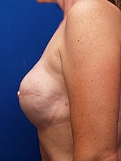 Breast Reconstruction Before & After