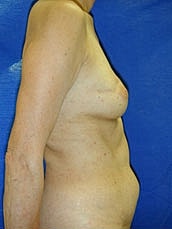 Breast Reconstruction Before & After